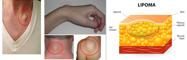 Cara Menghilangkan Lipoma Tanpa Operasi Sampai Tuntas Cara Menghilangkan Lipoma Tanpa Operasi Sampai Tuntas