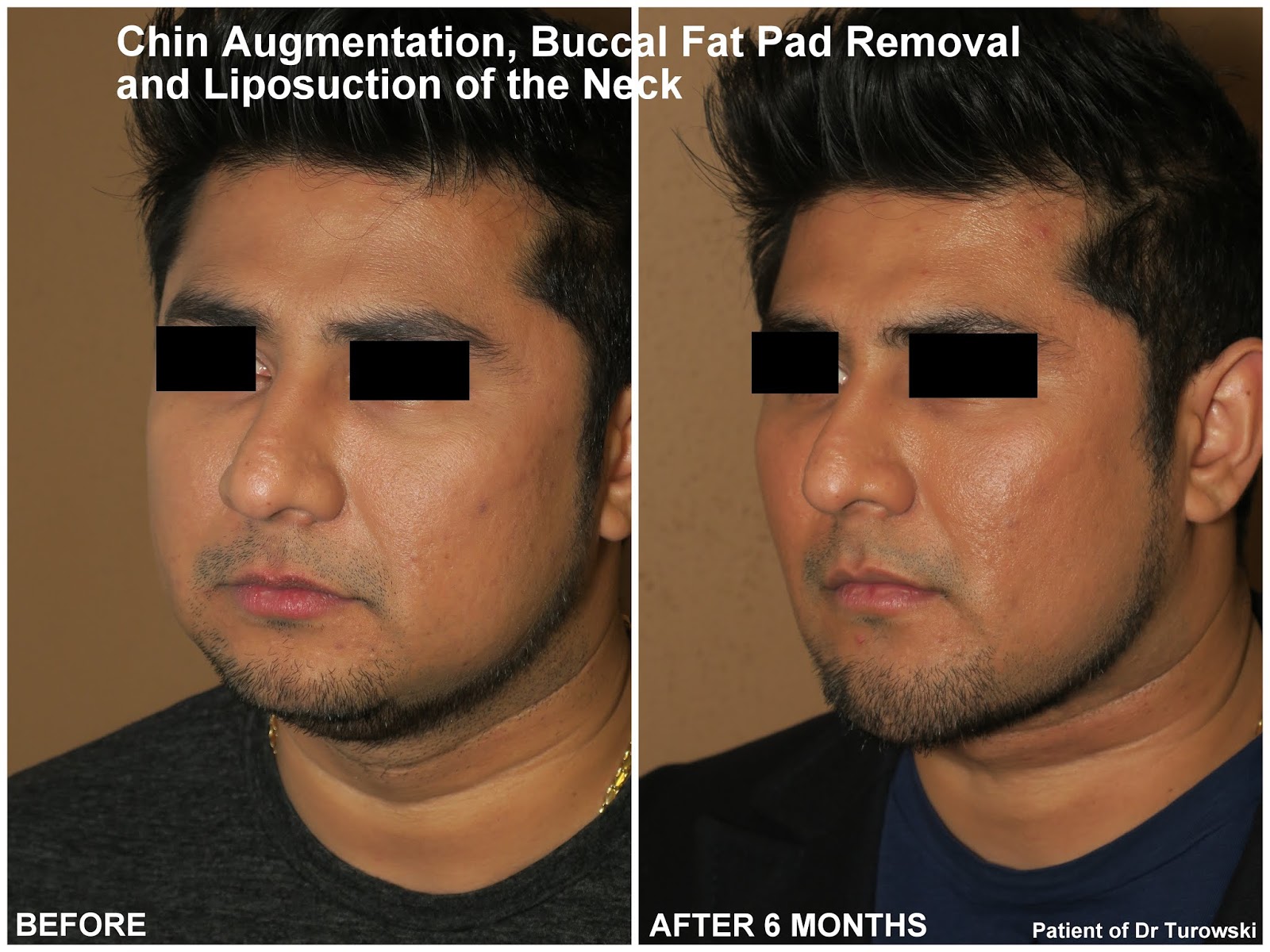 New Horizons Plastic Surgery Chin Augmentation, Buccal Fat Pad Removal