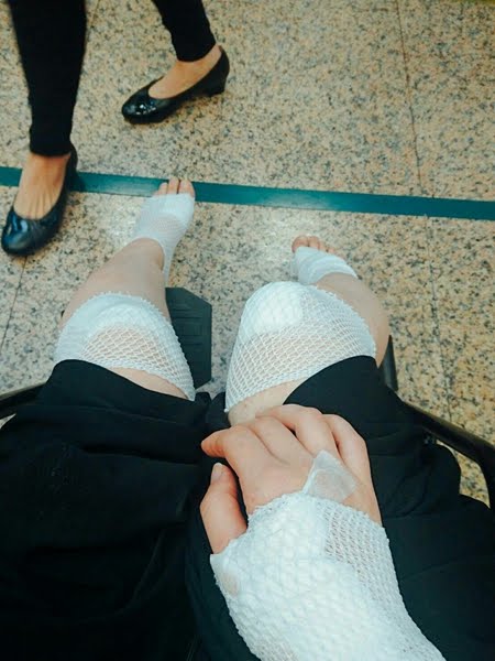 【車禍日記】傷口養護心得全紀錄，還我一雙漂亮美腿！〝結束更新〞