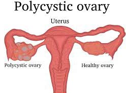 Polycystic Ovarian Symptoms Saw-palmetto aids in healing Polycystic Ovarian Symptoms (PCOS) in females who have superior stages of androgenic hormone or testosterone. It also manages greater stages of estrogen.