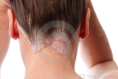 How To Cure Eczema: Hair Loss Caused By Eczema