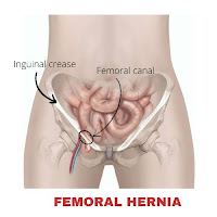 Femoral hernia फेमोरल हर्निया