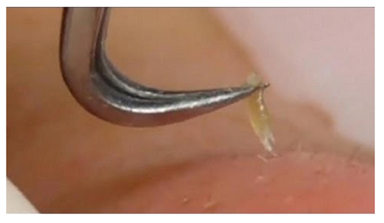 how to removal blackheads whiteheads on the face easy acne how do whiteheads form