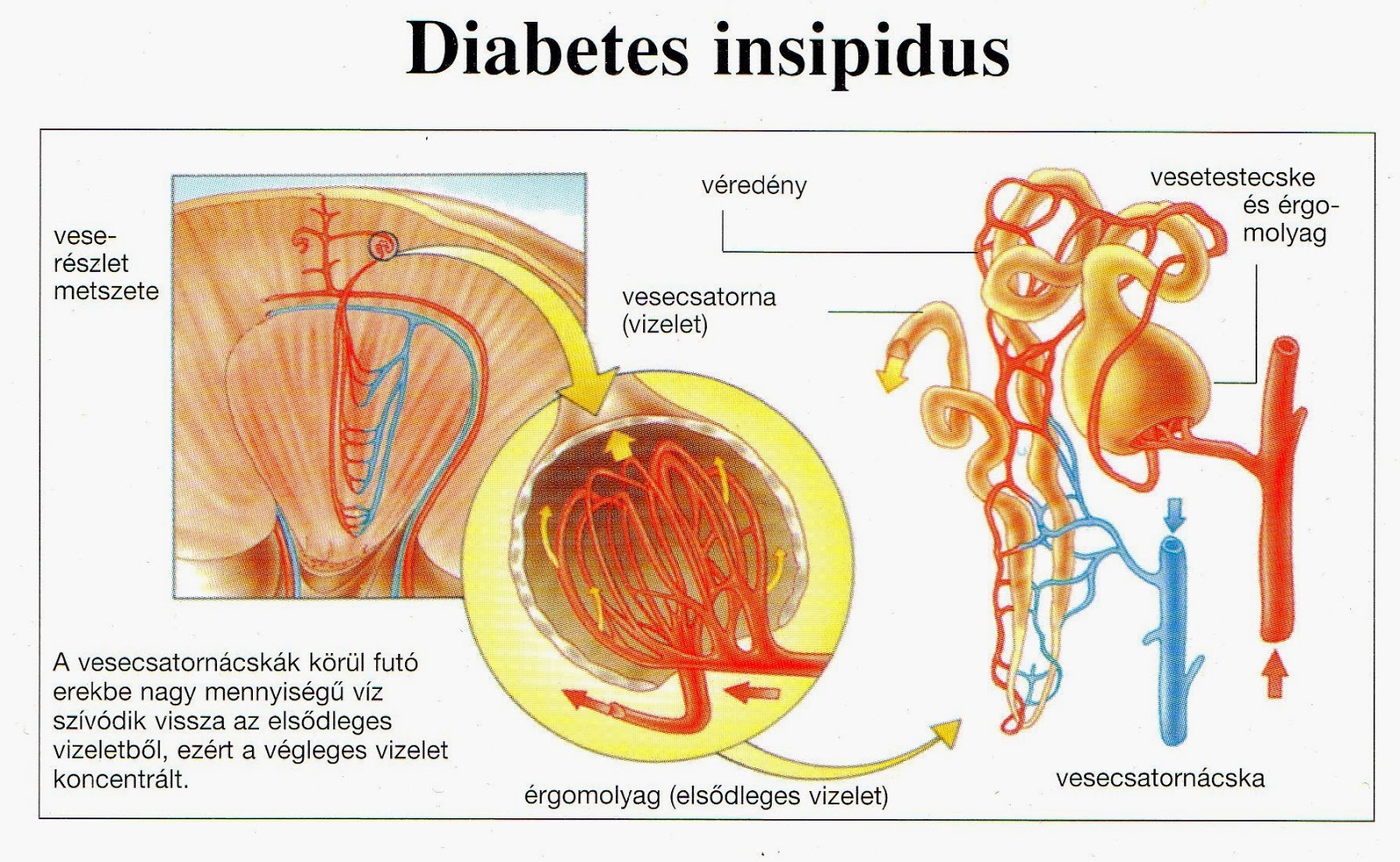 Cara Menyembuhkan Penyakit Diabetes Insipidus