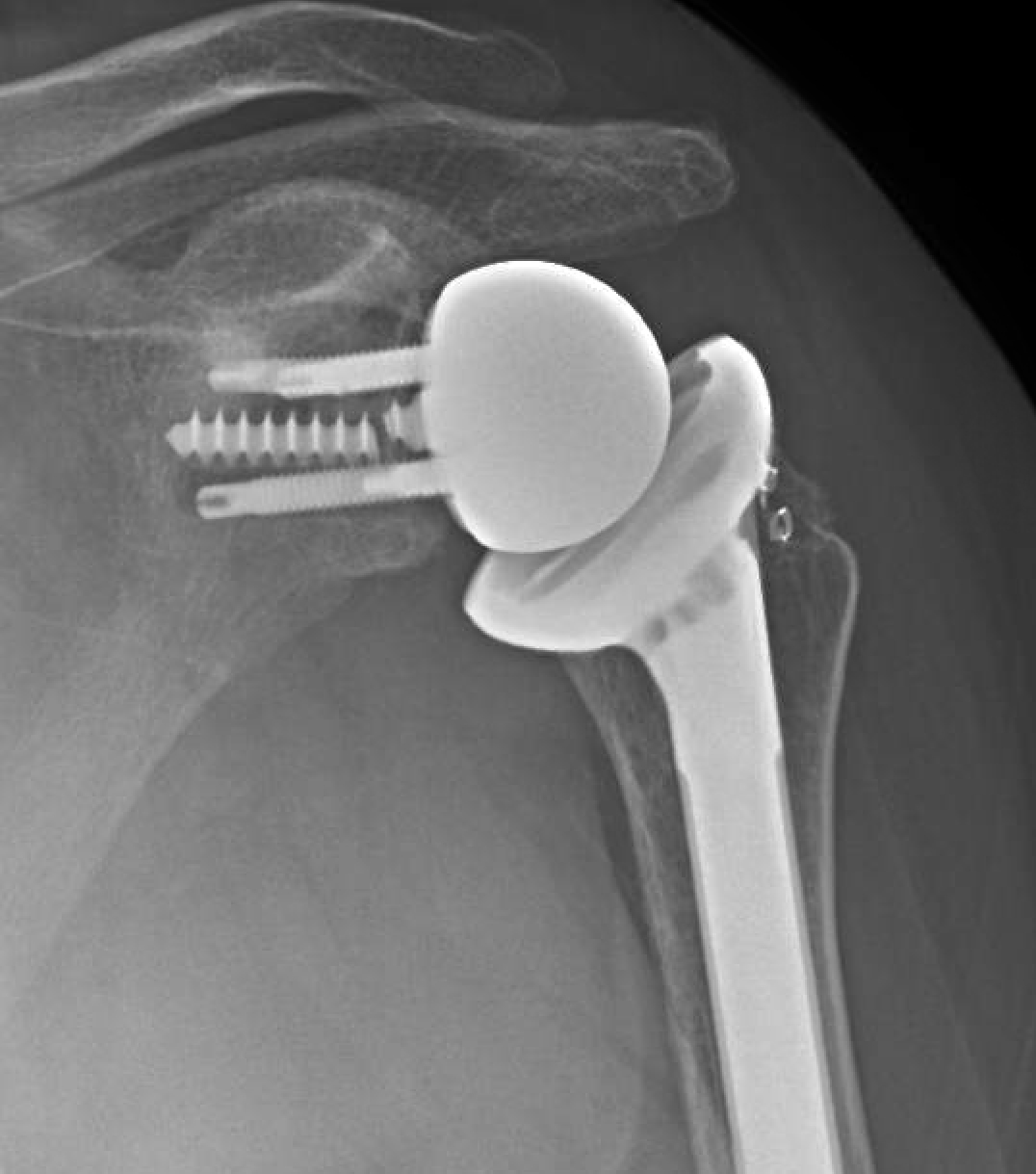 Shoulder Arthritis / Joint Replacement Reverse total shoulder