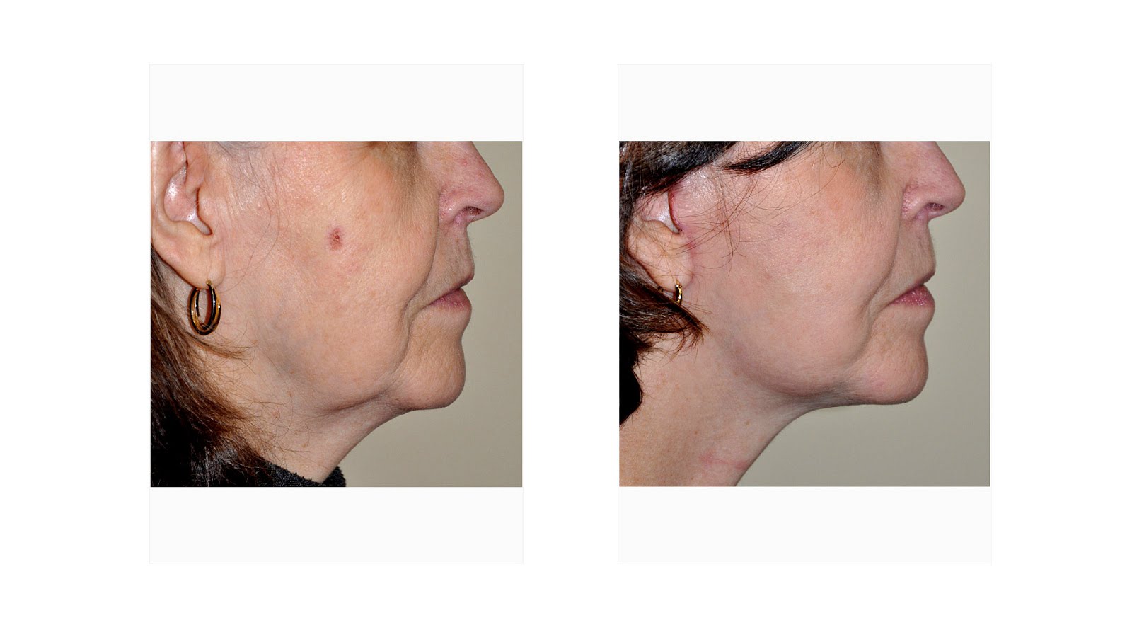 Quick Lift Facelift Cost Lift Choices