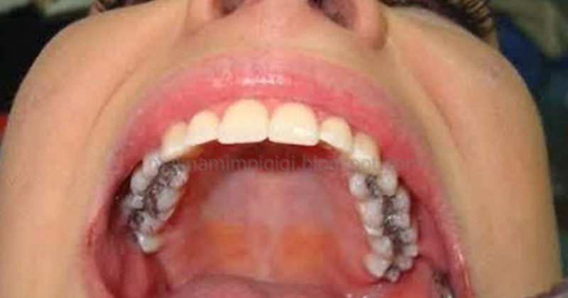 6+ Arti Mimpi Gigi Geraham Berlubang