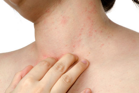 Penyakit Autoimun Penyebab Kakak Shireen Sungkar Meninggal Dunia, Waspadai 9 Gejala Penyakit Mematikan Ini Penyakit Autoimun Penyebab Kakak Shireen Sungkar Meninggal Dunia, Waspadai 9 Gejala Penyakit Mematikan Ini