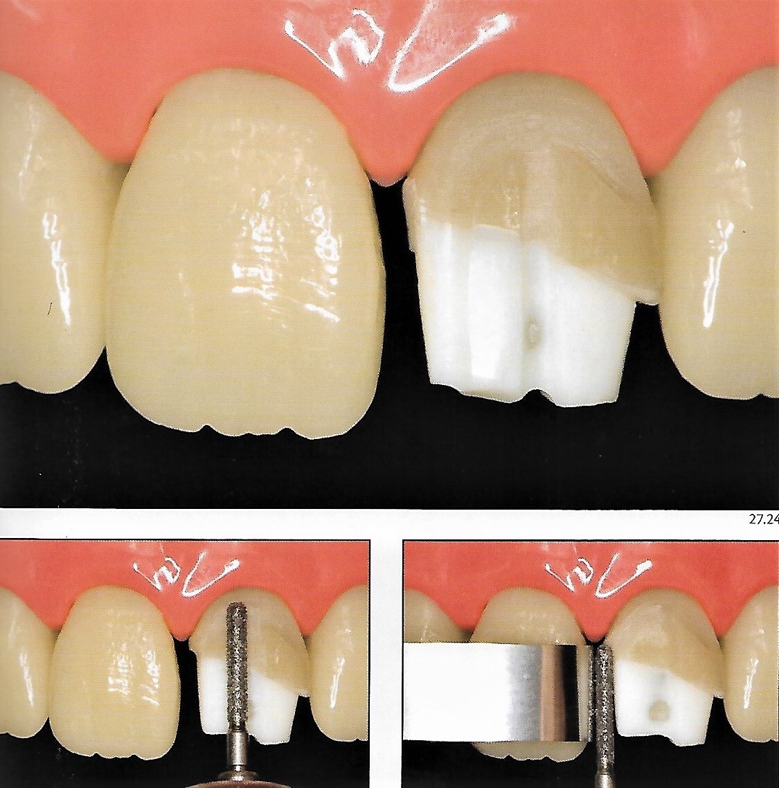 Anterior Crown Preparation Dental Esthetics