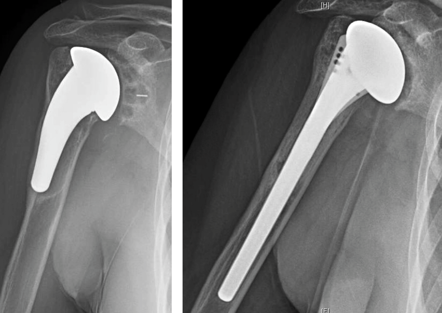 UW Shoulder and Elbow Academy Treatment of glenoid component loosening
