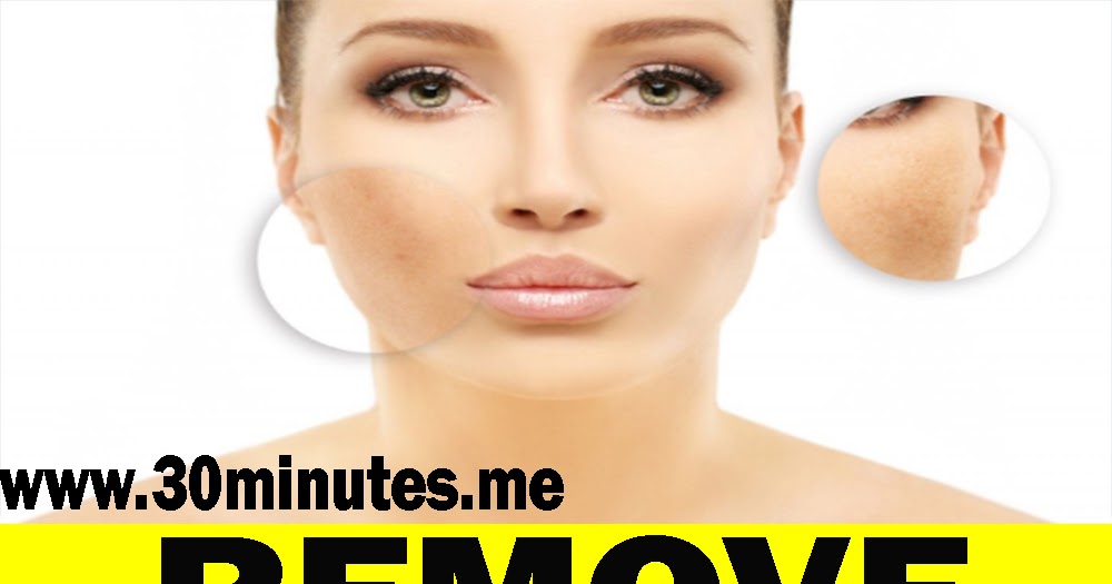 I’M SHOCKED IT REMOVED MY DARK SPOTS IN 3 DAYS, POTATO & LEMON JUICE