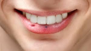 dudak ustu siyah noktalar dudak