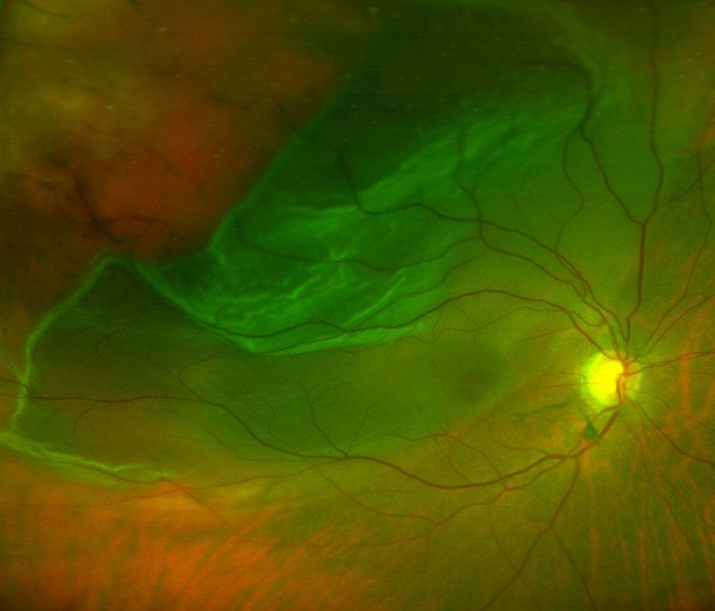 retina surgery recovery products retina surgery recovery products