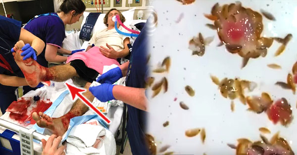 This teen dips his feet into the water but ends up getting a bloodied feet after the flesh-eating bugs fed on his feet! 