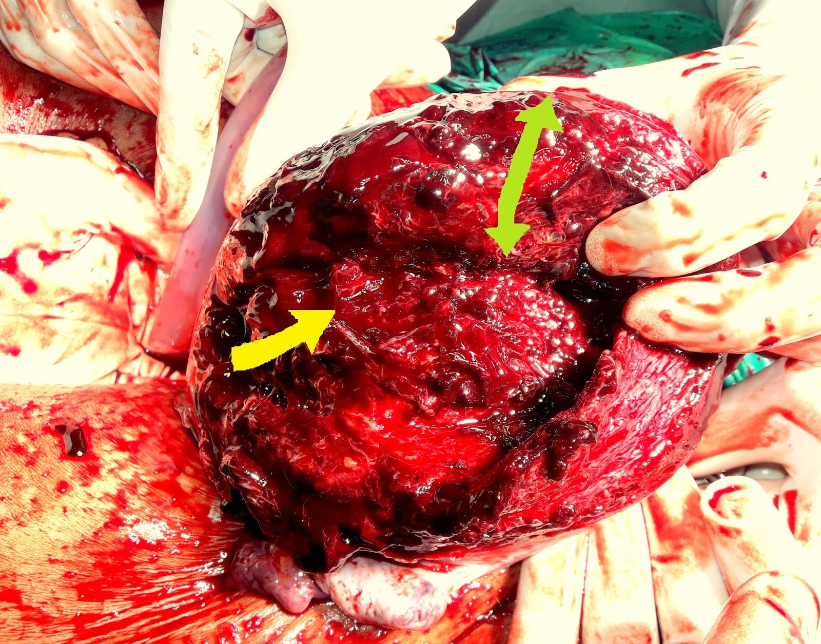 uterus shifted to the left uterus shifted to the left
