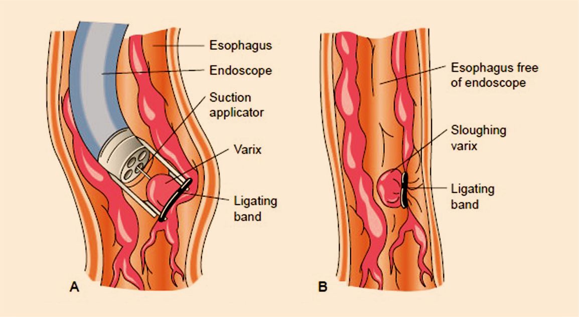 Esophageal (Endoscopic) Variceal Band Ligation by Vishwa Gastro