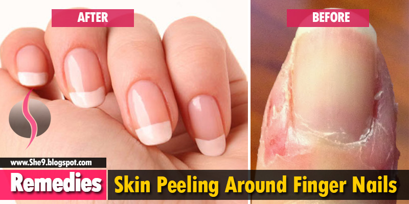 Skin Peeling on Fingers - My Healthy Feeling