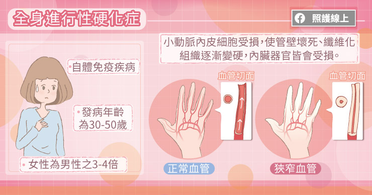 全身進行性硬化症