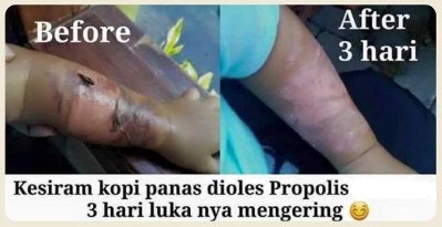 Obat Tetes Untuk Luka Bakar Agar Cepat Kering dan Sembuh ~ WALATRA PROPOLIS BRAZIL Obat Tetes Untuk Luka Bakar Agar Cepat Kering dan Sembuh ~ WALATRA PROPOLIS BRAZIL