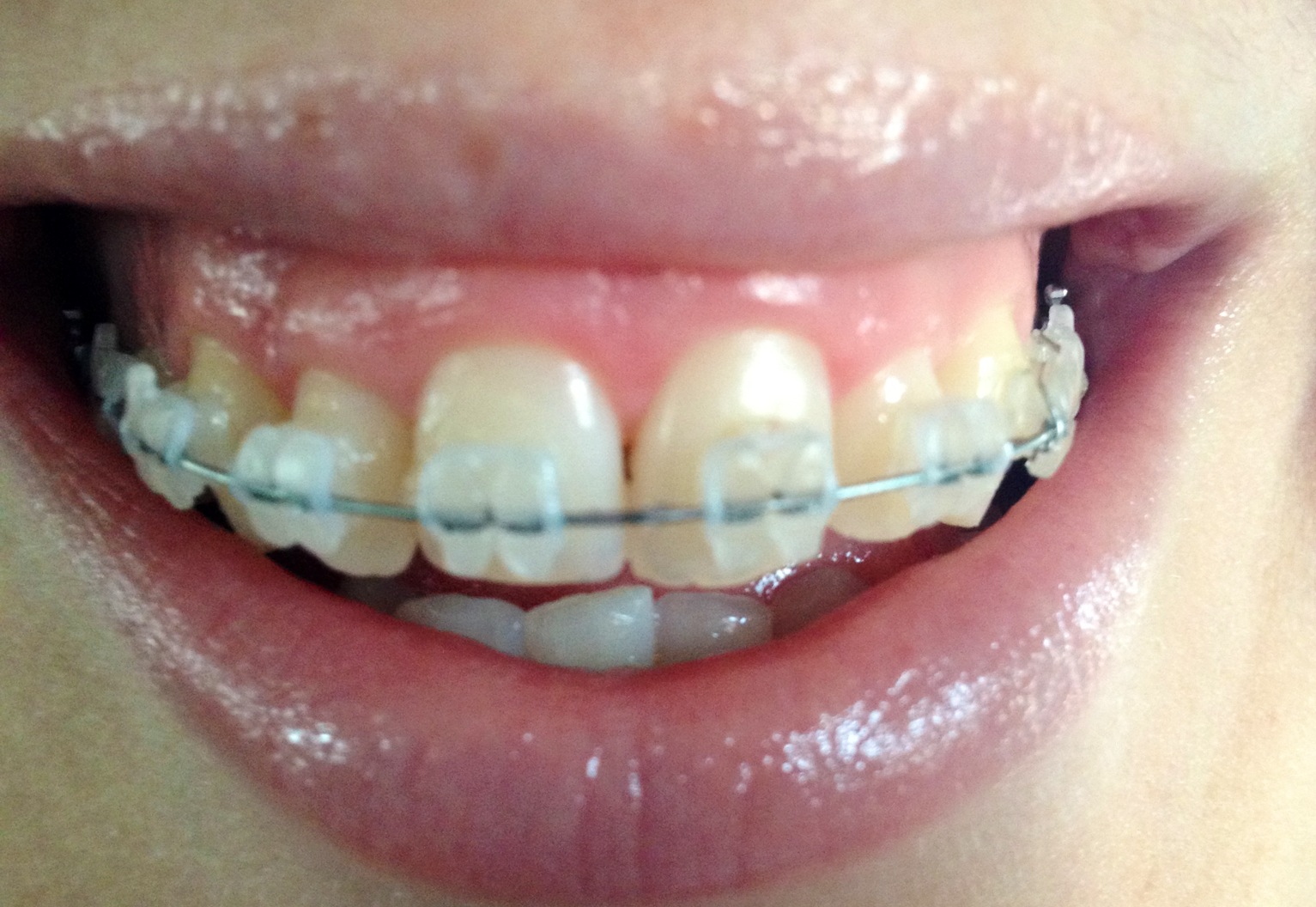 Braces Chick Change Isn't Always Good