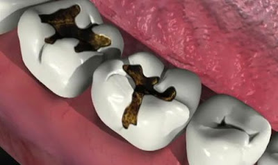 Xử lý tốt nhất tình trạng sâu răng dẫn đến hôi miệng-1