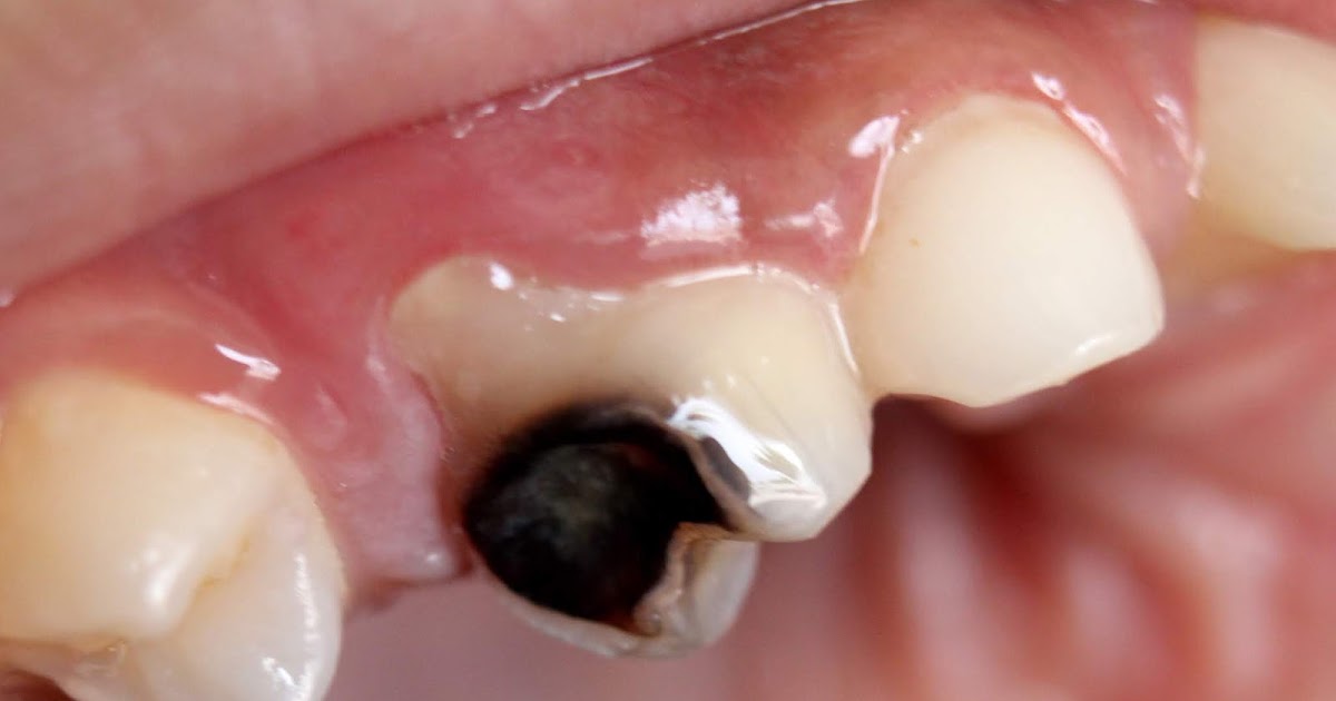 Cavities (Dental Caries). HEALTH INFORMATION