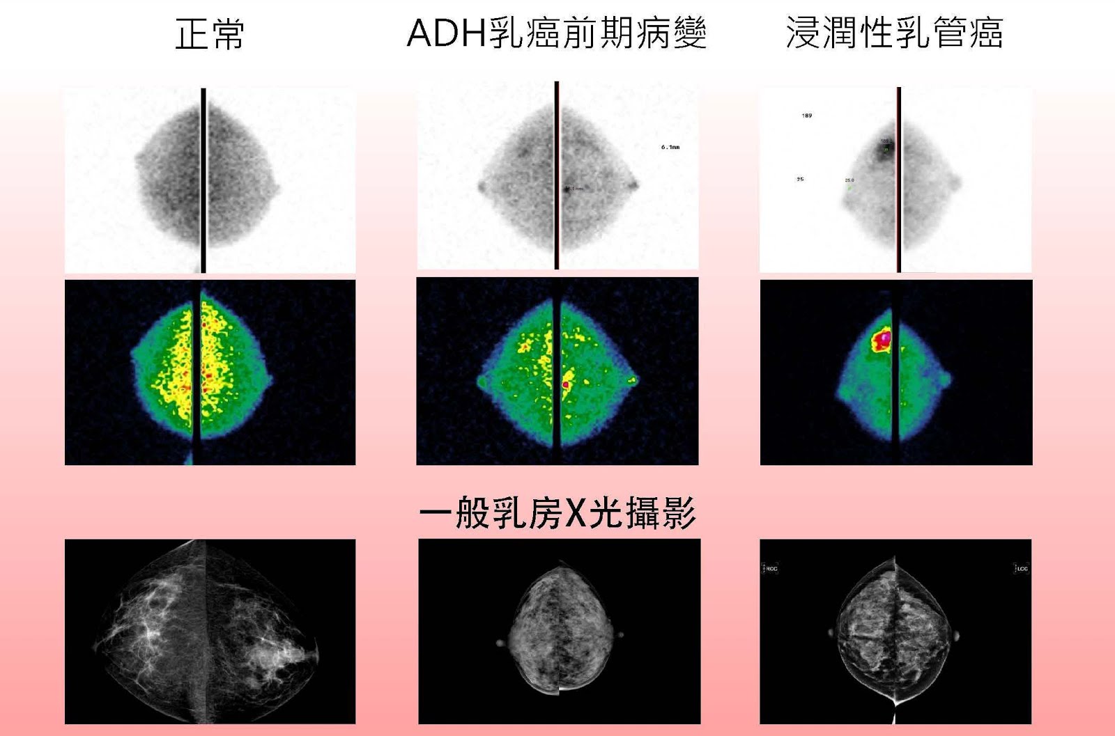 次世代乳癌檢測利器(乳房分子影像MBI)