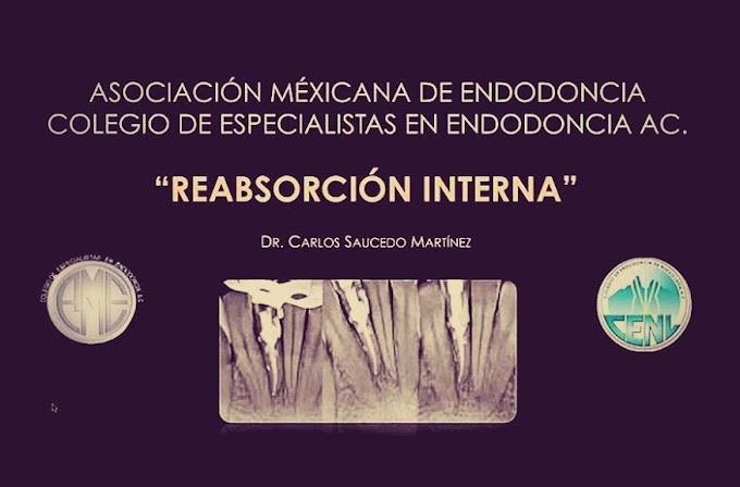 ENDODONCIA: Reabsorción Interna - Videoconferencia del Dr. Carlos A. Saucedo