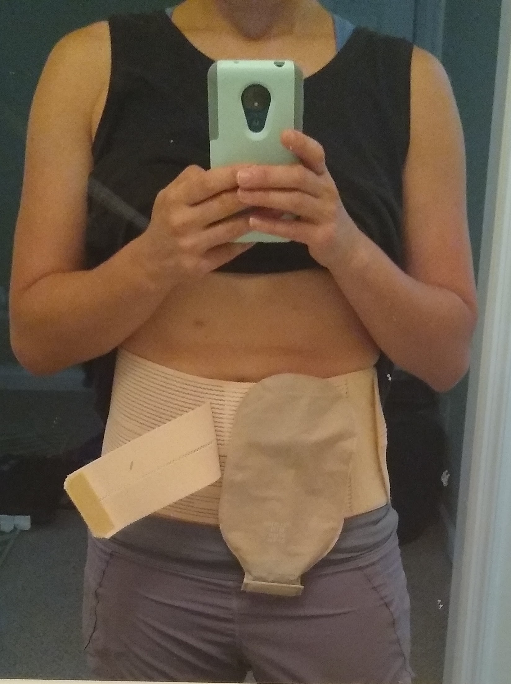 My Stoma Prolapsed!(Warning Stoma Pics may be disturbing)