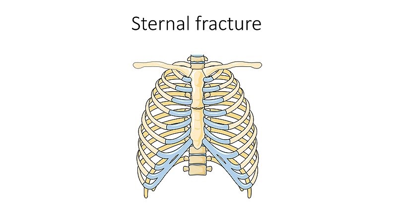 Sternum Fracture Treatment Sternum Bone Fracture Surgery