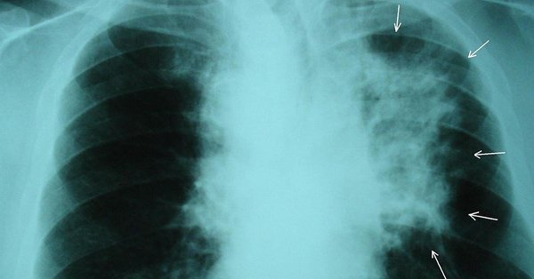 google IA cancer de pulmon