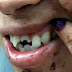 CRUEL: Após ficar dois dias fora de casa, marido bêbado quebra dente de mulher na porrada