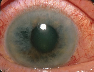 Closure glucoma ,eyes disease