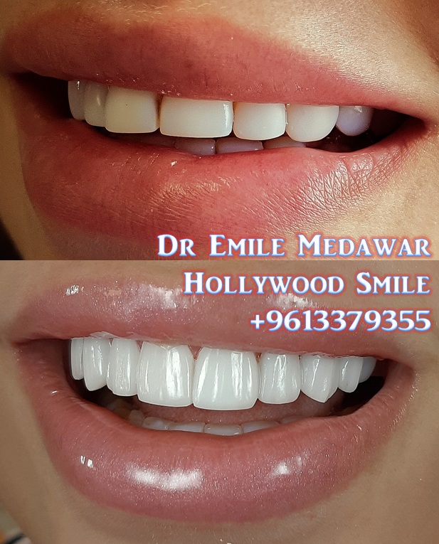 EMax Veneer, Dr Emile Medawar, 00 961 3 379355 Porcelain Veneers, E