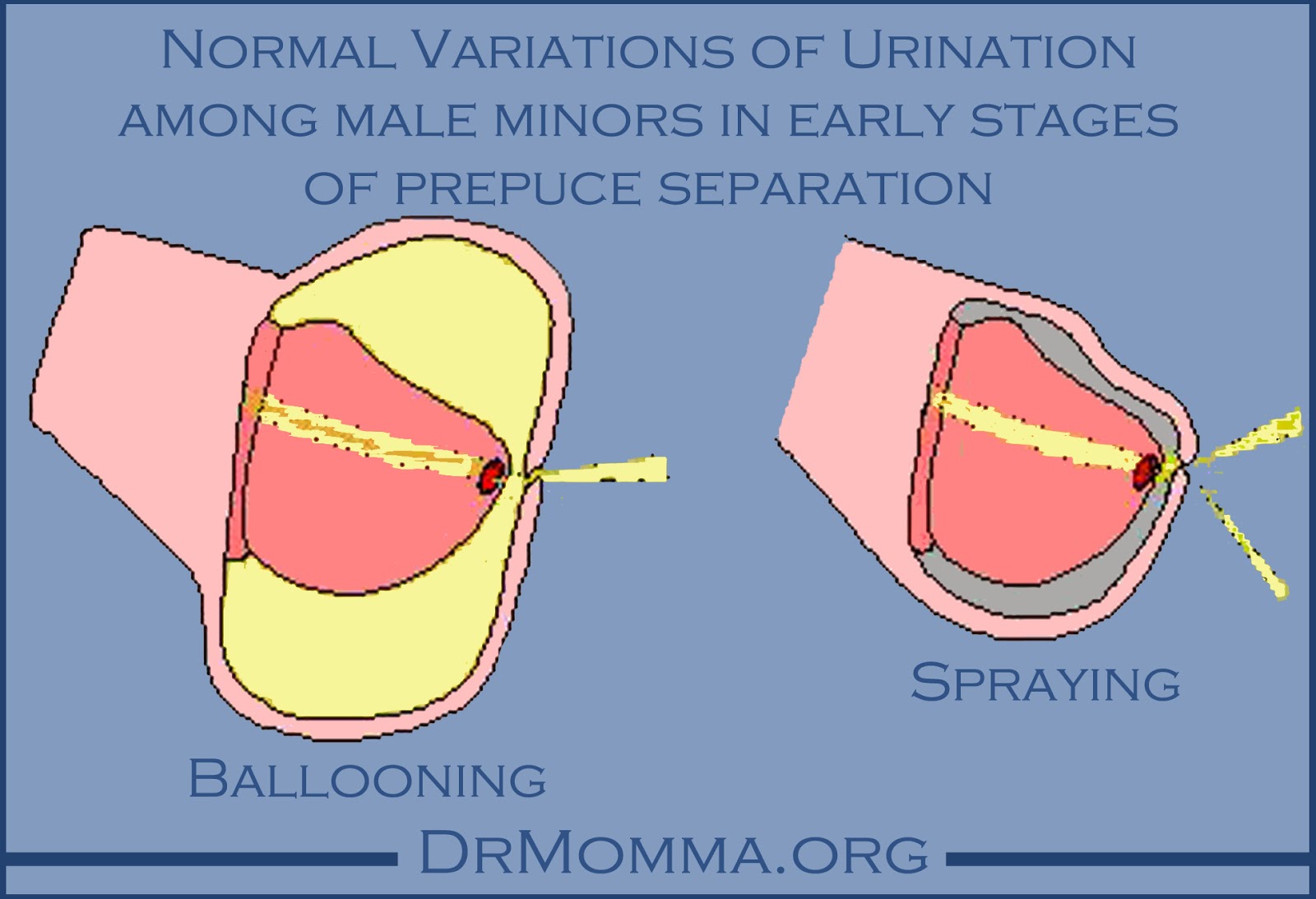 Saving Our Sons Extreme Ballooning in the Intact Child