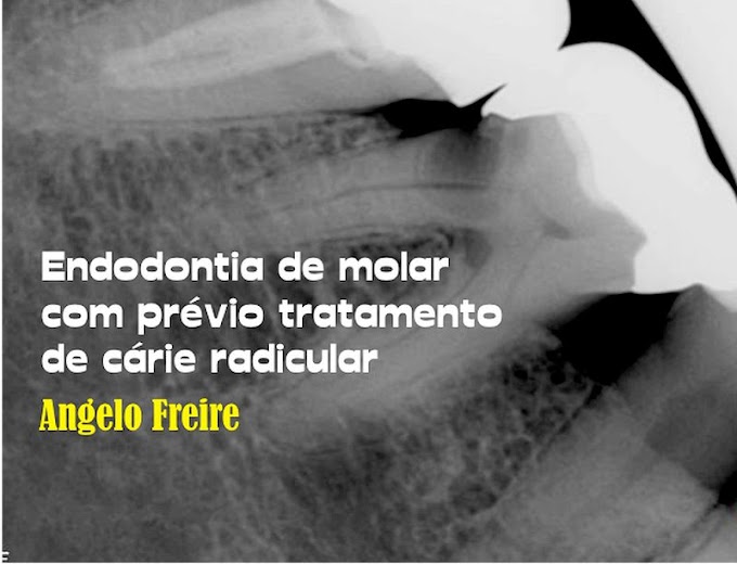 ENDODONTIA de molar com prévio tratamento de cárie radicular - Angelo Freire