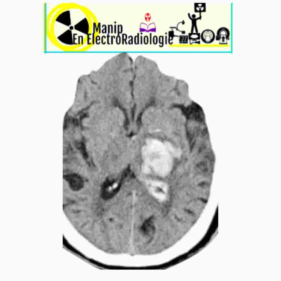 Accident vasculaire cérébral (AVC) hémorragiques TDM cérébral interprétation