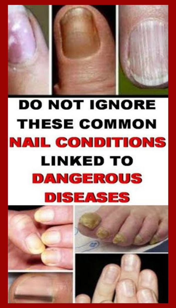 Do Not Ignore These Nail Conditions Linked To Serious Diseases