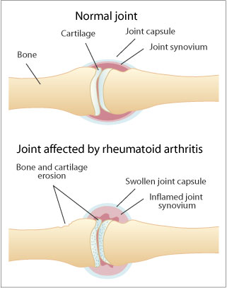Knowledge Deficit NCP Rheumatoid Arthritis | List of Nursing Diagnosis