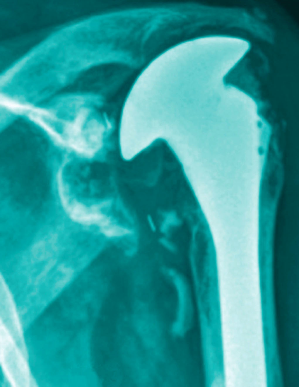Shoulder Arthritis / Joint Replacement Secondary Rotator Cuff