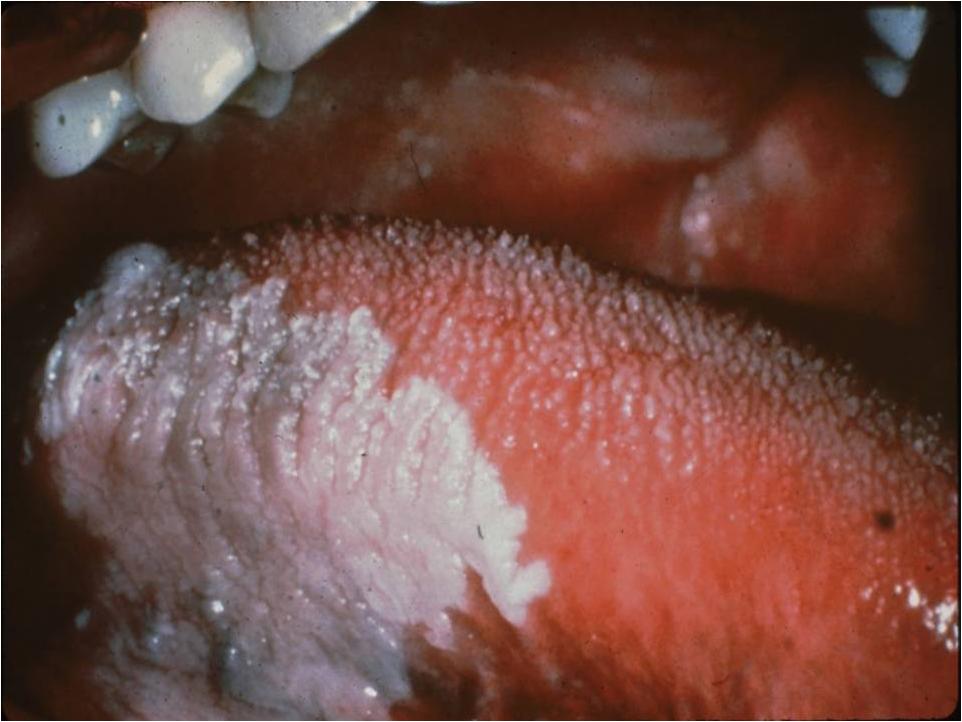 Oral Hairy Leukoplakia | Johns Hopkins Medicine Health Library