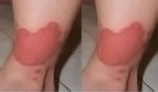 psoriasis, herpes, diabetes, and arthritis psoriasis, herpes, diabetes, and arthritis