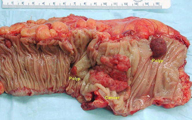 cancer de colon etapa 3