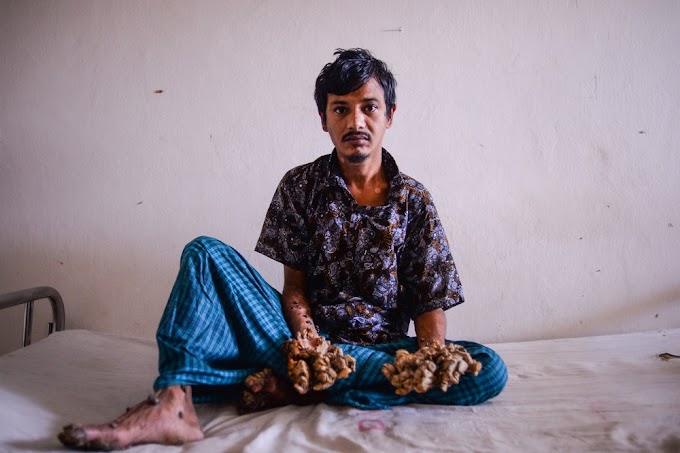 O 'homem-árvore' pede para que suas mãos sejam amputadas