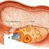 Health : The 10 causes of breast cancer in women