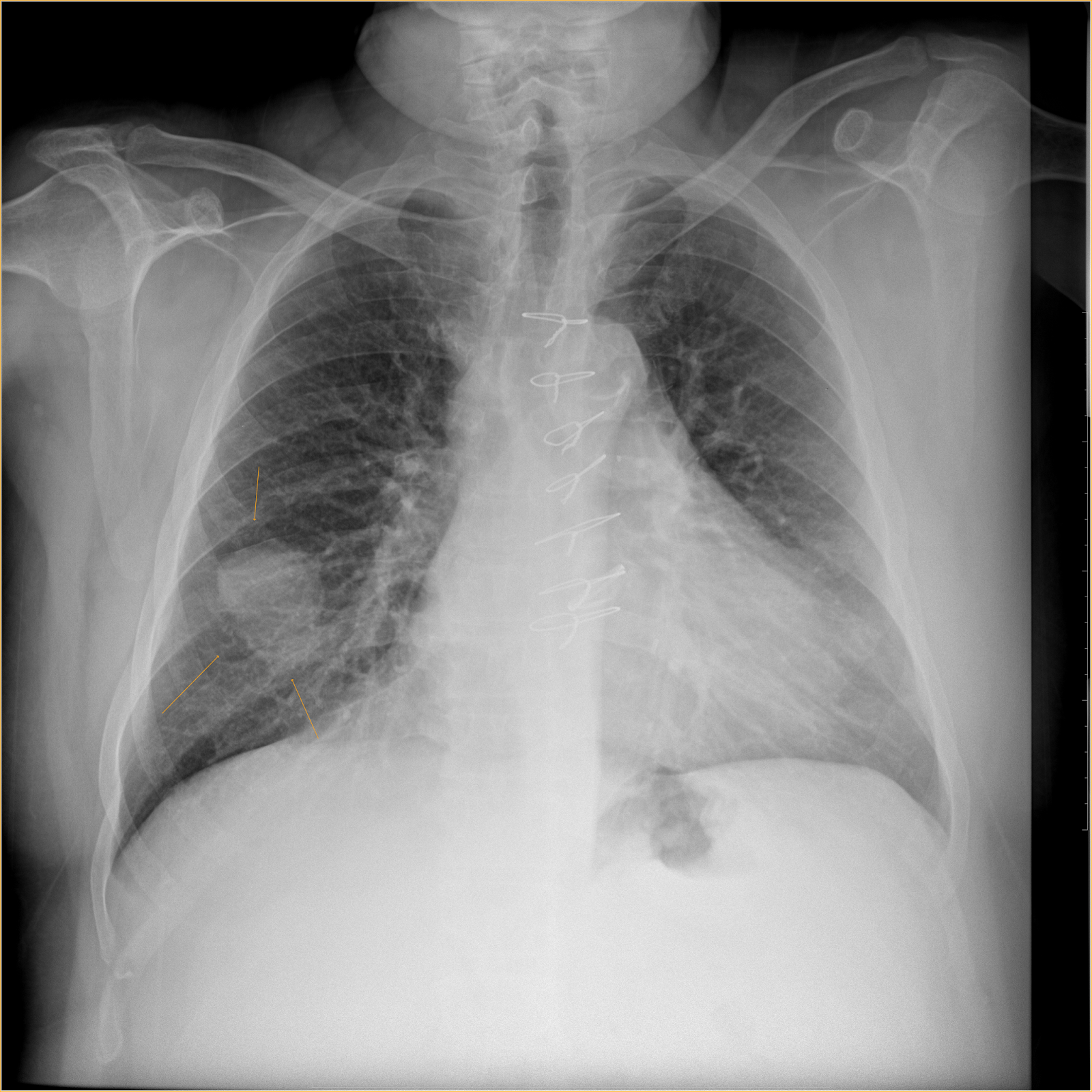 nodule ct pulmonary solitary lung radiology biopsy