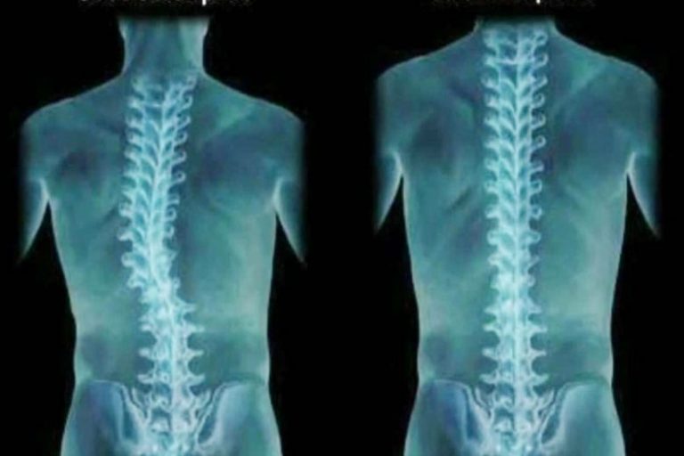 Skoliosis Tulang Belakang Membengkok Qiya Beauty