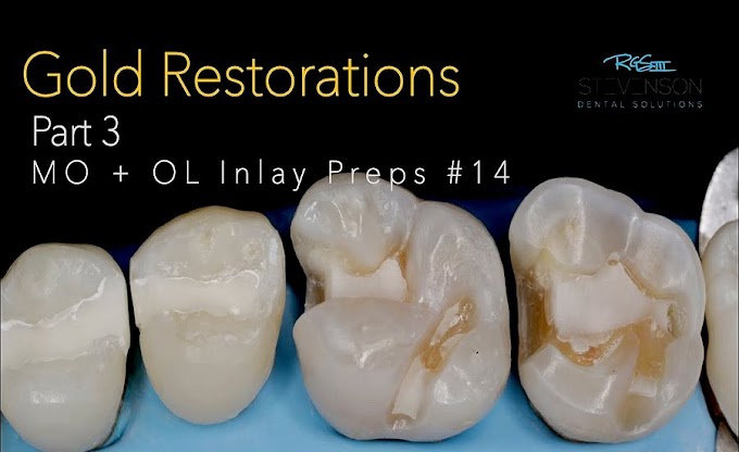 CAST GOLD Restorations - PART 3: MO + OL INLAY PREPS #14 -  Dr. Richard Stevenson