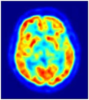 <Img src ="Tomografía-emisión-positrones.jpg" width = "189 height "213" border = "0" alt = "Tomografía del cerebro por emisión de positrones.">