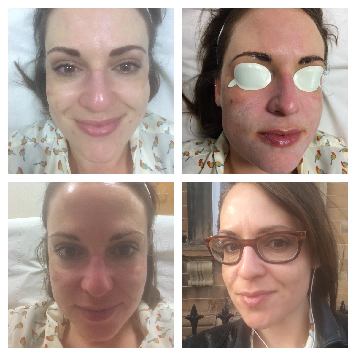 BeautyH2T Glasgow Reviewed; Obagi Blue Radiance Peel at Transform